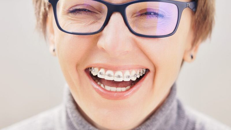 The Benefits of Braces For Adults